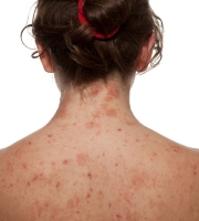 What To Do If You Have Contact Dermatitis