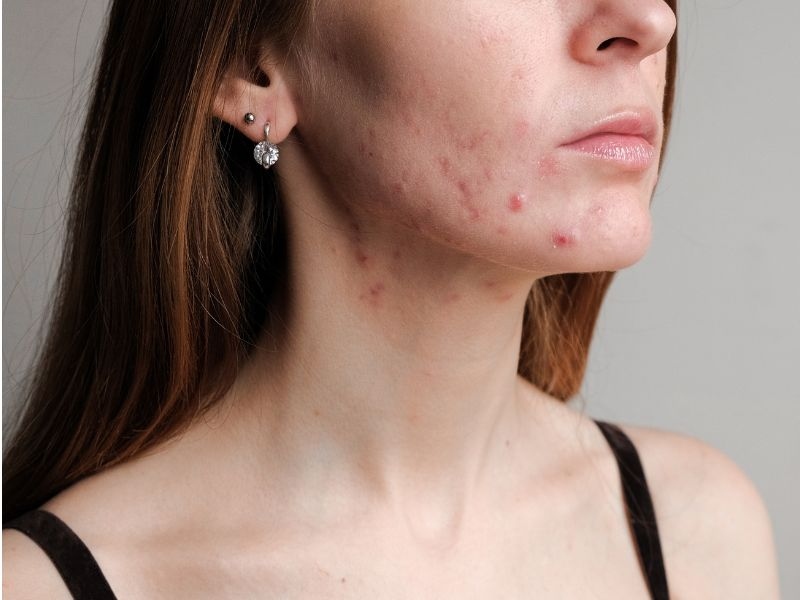 Acne: The World's Greatest Teenager Problem
